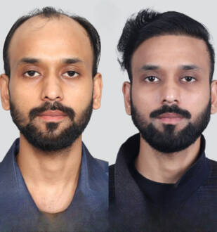 hair transplant