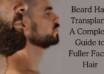 beard hair transplant