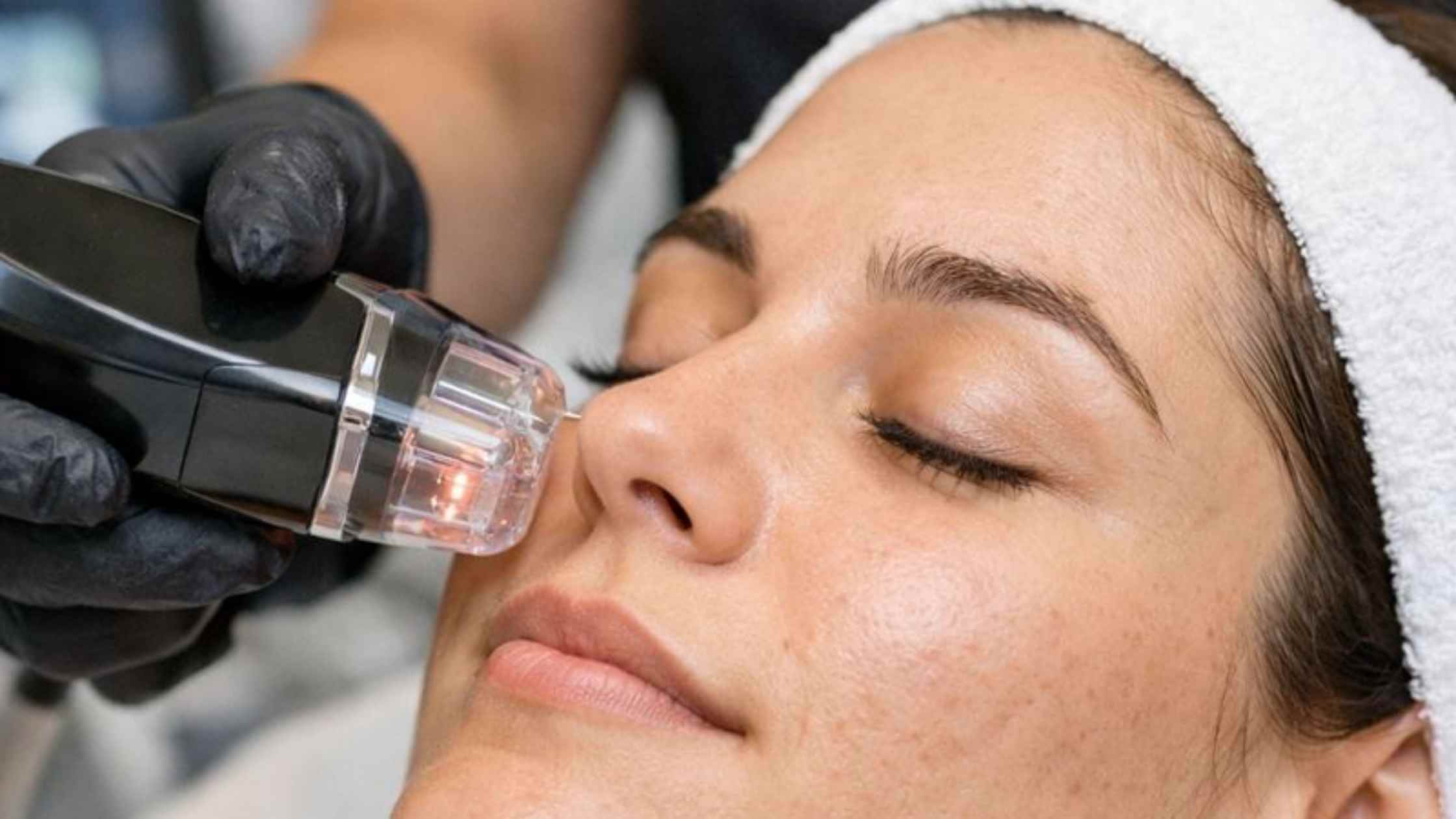 How Morpheus8 Improves Acne Scars (1)