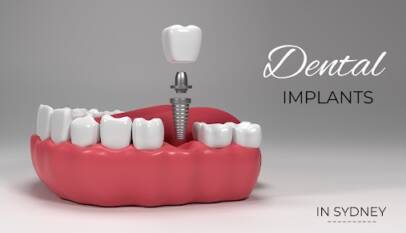 dental implants cost in sydney
