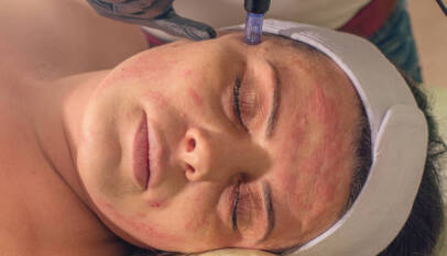 how much is microneedling